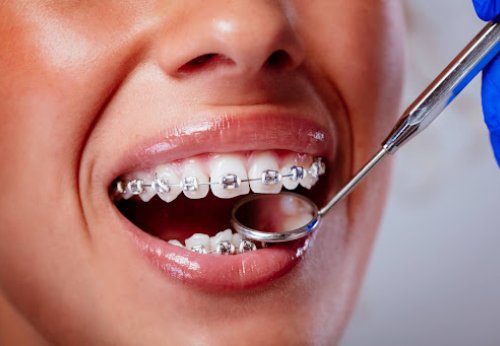 Prix des Broches: Combien Coûte un Traitement Orthodontique au Québec ?